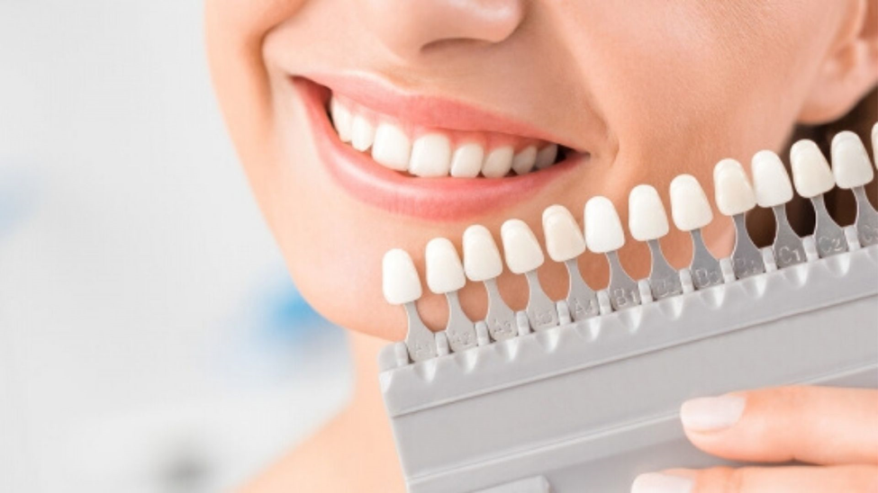 A Beginners Guide To Veneers Procedure